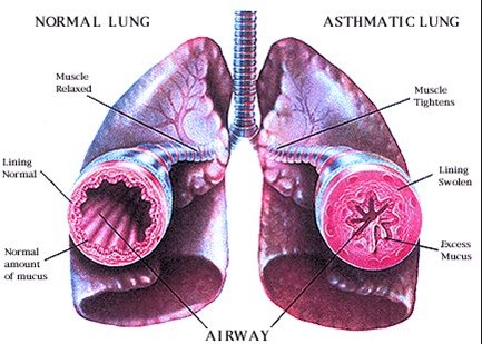 asthmah.jpg